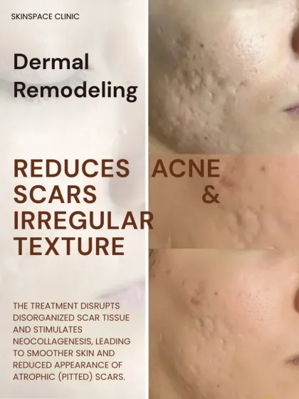 This is how dermal remodeling works to reduce acne scars. The treatment breaks down disorganized scar tissue and stimulates neocollagenesis, or the formation of new collagen. This leads to smoother skin and a visible reduction in pitted, atrophic scars.