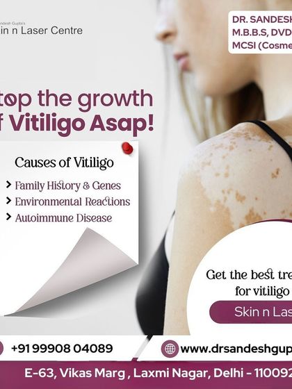 It is important to stop the growth of Vitiligo as soon as you notice it. It can be caused by family history or autoimmune reactions, and I provide the best treatment at my Skin n Laser clinic.