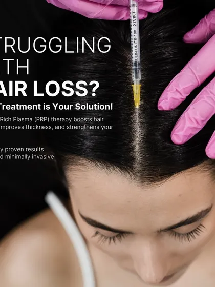 Here you can see a Platelet-Rich Plasma (PRP) treatment in progress. This procedure uses the healing power of your own blood to boost natural hair growth and improve thickness. It is a safe, minimally invasive, and clinically proven solution for tackling hair loss at the root.