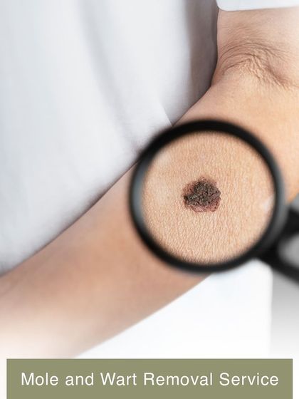 This image shows a mole being examined, representing my mole and wart removal service. I ensure the procedure is done safely and with precision.