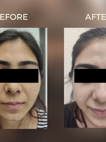 This before and after image shows the transformative results of Microneedling RF. The treatment significantly improved the client's skin texture and reduced the appearance of acne, leading to clearer, smoother skin and renewed confidence.