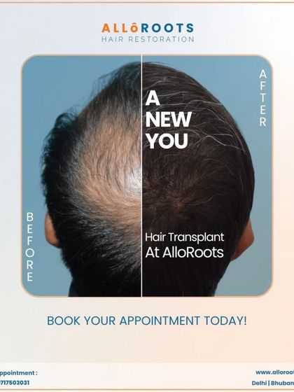 This image encapsulates the goal of my work: to give you a new beginning. The split view clearly shows the significant coverage achieved, turning back the clock on hair loss.