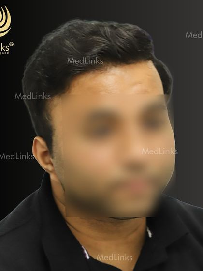 The final result from the side, showing a natural and full hairline.