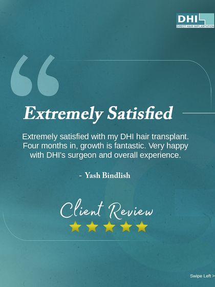 **Client Review: Extremely Satisfied:** Four months into his journey, Yash Bindlish is extremely satisfied with his DHI hair transplant. He is very happy with the fantastic growth, his surgeon, and the overall experience.