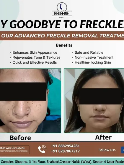 Many people think they have to live with freckles or sun spots, but that's not true. This before-and-after shows a significant reduction in freckles, resulting in a more uniform and clear skin tone.