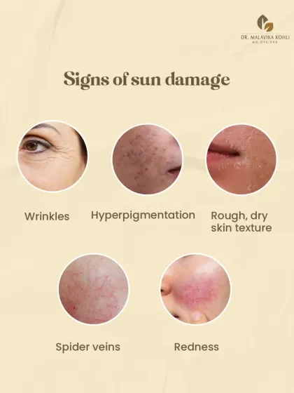 Sun damage, or photoaging, manifests in several distinct ways. These include wrinkles, hyperpigmentation, rough skin texture, the appearance of spider veins (telangiectasias), and generalized redness. Recognizing these signs is the first step toward correction and prevention.