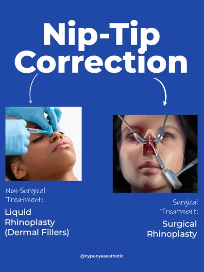 For nose tip correction, non-surgical liquid rhinoplasty with dermal fillers can provide a subtle tweak. For a full structural change, surgical rhinoplasty is the answer.