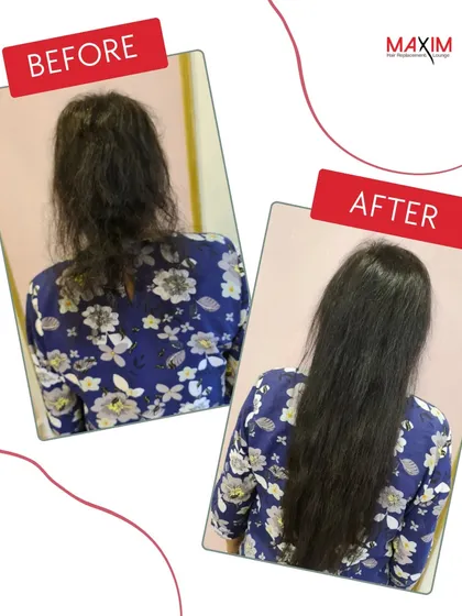 This back view highlights the significant improvement in hair density and health. We took her hair from thin and wispy to full and luxurious with a set of perfectly matched straight extensions.