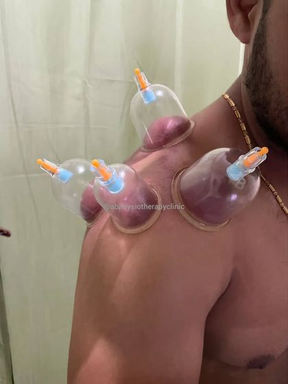 Applying cups to the shoulder and deltoid area is excellent for anyone experiencing pain from overhead activities or gym workouts.