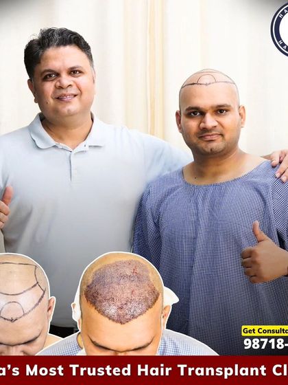 Tackling Grade 5 baldness requires a comprehensive approach. With 4559 grafts, we were able to restore significant coverage for this patient, as you can see from the pre-op design to the post-op result.