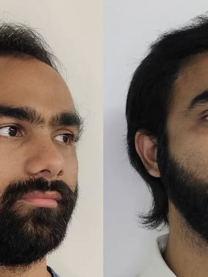 Another perspective on this fantastic result, showing how a well-executed hair transplant can truly turn back the clock.