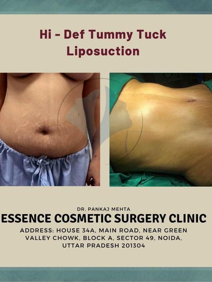 This side-angle view shows the results of a high-definition tummy tuck and liposuction. It emphasizes the significant reduction in abdominal protrusion and the newly sculpted profile.