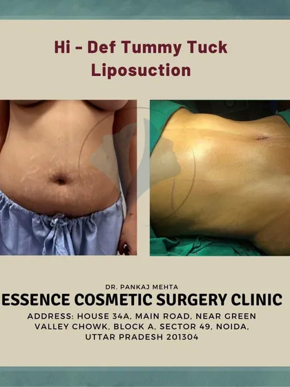 This before and after image shows the side profile result of a high-definition tummy tuck. It effectively demonstrates the reduction in abdominal projection and the creation of a smoother, more defined waistline.