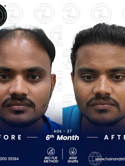 The frontal view at 6 months reveals a much stronger and more defined hairline, completely changing the patient's appearance.
