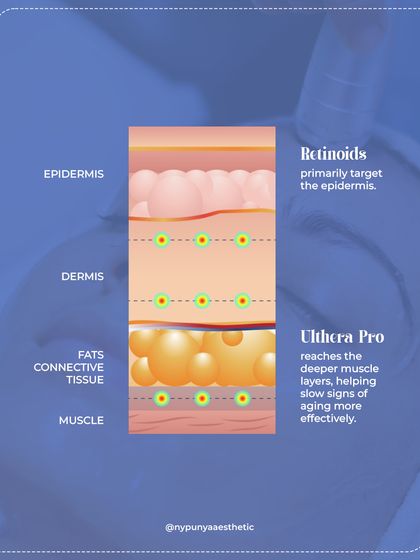 This diagram shows how retinoids primarily target the epidermis, the top layer of skin. For deeper signs of aging in the dermis and muscle layers, we need treatments like Ulthera Pro or HIFU that can reach those connective tissues more effectively.