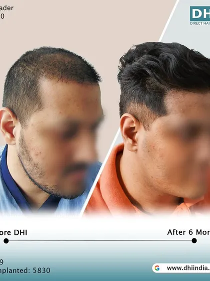 A side-profile view of the same client's 6-month progress. The restored hairline and increased thickness are clearly visible, showcasing a natural and youthful result.