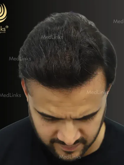 The 'after' top-down view, demonstrating the excellent density and coverage achieved across the entire transplant area.