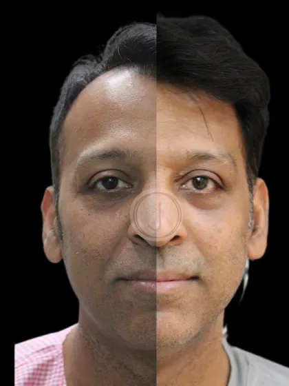 This transformation highlights the results of a dedicated skincare plan for men. After addressing dehydration and mild sagging with skin tightening and hydration procedures, the patient's skin looks visibly brighter, healthier, and more youthful.