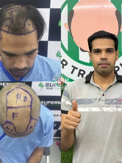 This collage shows the 6-month progress. We map out the transplant area carefully to ensure full coverage and a natural look.