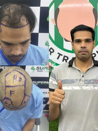 This collage shows the 6-month progress. We map out the transplant area carefully to ensure full coverage and a natural look.