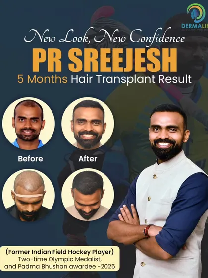 I had the honor of helping PR Sreejesh, the legendary Indian hockey player, restore his hair. This before-and-after collage shows his significant progress just 5 months into the journey, demonstrating how effective a well-planned transplant can be.