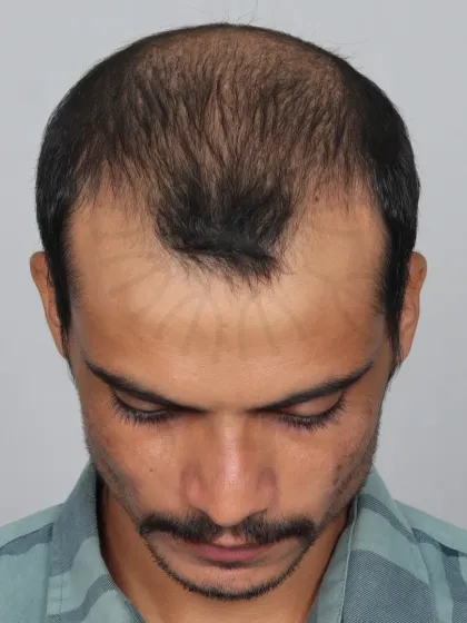 This 33-month result for a Grade 6 patient shows the long-lasting and natural outcome of his 4700-graft procedure.