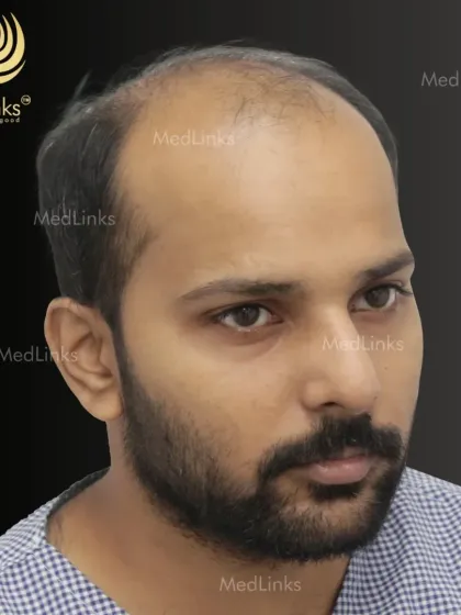 A before shot of a patient experiencing significant frontal and mid-scalp thinning. This is a common pattern of male pattern baldness that we frequently address at our clinic.