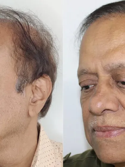 This angle shows the natural-looking density and the soft hairline we created, which is crucial for a patient with this level of initial hair loss.