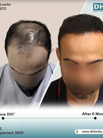 A before and after of a 43-year-old client 6 months post-procedure. With 5,839 hairs implanted, his hair is now dense, stylish, and completely natural-looking.