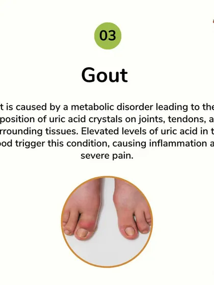Gout is a painful condition caused by uric acid crystal deposits in the joints. I use a combination of diet, herbs, and therapies to manage the underlying metabolic disorder, reducing inflammation and preventing future flare-ups.