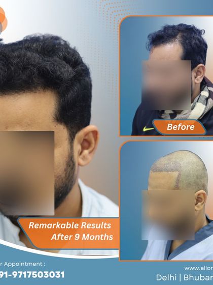 Remarkable results after just 9 months. This series shows the before, post-op, and after stages, highlighting the efficiency and effectiveness of the procedure.