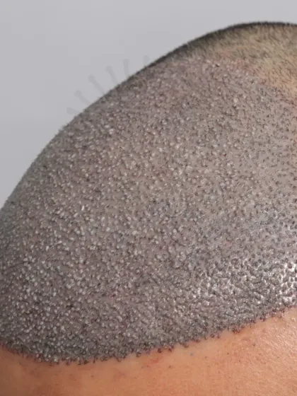 The start of a journey for a Diffuse Grade 4A patient. 3500 grafts were used to recreate the hairline, frontal zone, and mid-scalp.