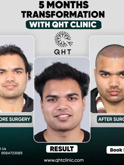 Lokesh Kumar's amazing transformation in just 5 months, covering his frontal hairline and mid-scalp.