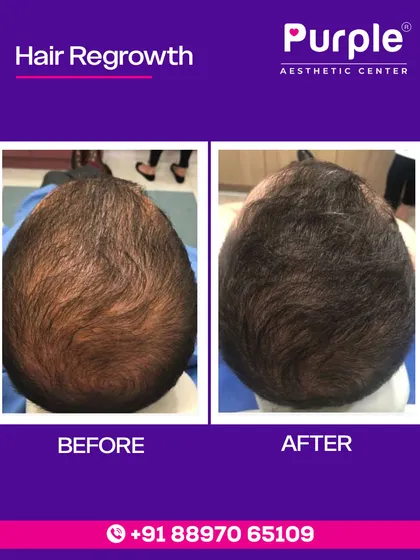 Don't let hair thinning affect your confidence. This before and after image shows the incredible results of our doctor-led hair regrowth treatments, helping you achieve visibly thicker and fuller hair.