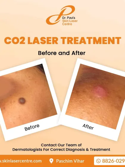 This image shows the removal of a single mole using the CO2 laser. You can see the 'before' state and the 'after' where the skin is healing cleanly post-procedure.