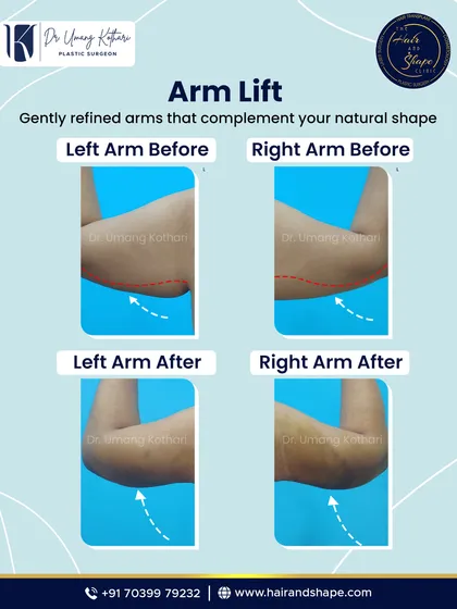 Sagging skin on the upper arms, often called "bat wings," is a common concern. An arm lift, or brachioplasty, is a procedure I perform to remove this loose skin and fat. The result is a smoother, more toned arm contour that complements your natural body shape, as you can see in this before and after.