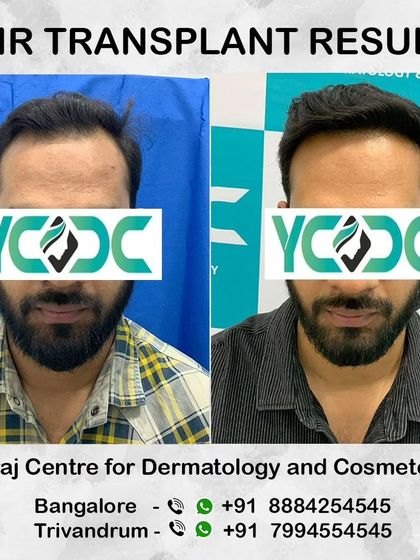 A frontal comparison showcasing the life-changing results of FUE surgery, restoring hair to areas of significant thinning.