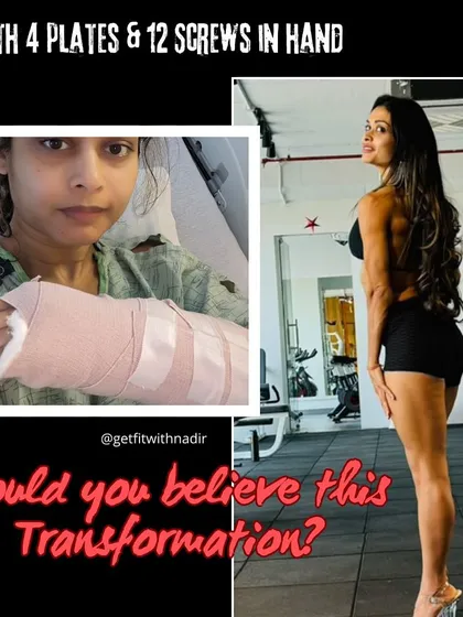 Would you believe this transformation was possible for someone with 4 plates and 12 screws in her hand? This is a testament to what can be achieved with expert guidance and an unbreakable will.