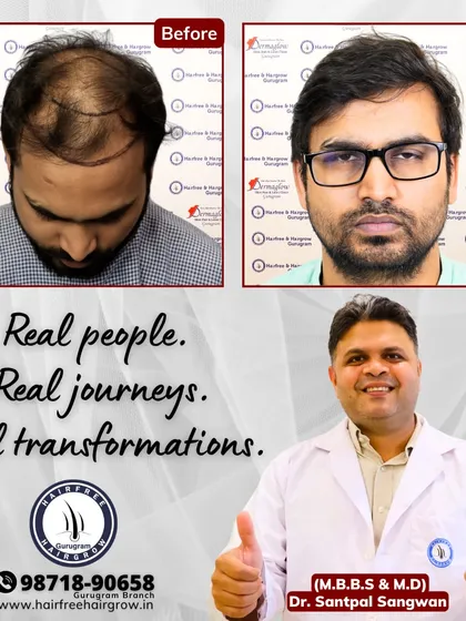 Real results come from real expertise. This patient came to me with Grade 5 baldness, and we achieved this full, natural look with 5200 grafts over 12 months. It's my commitment to each patient that drives these transformations.
