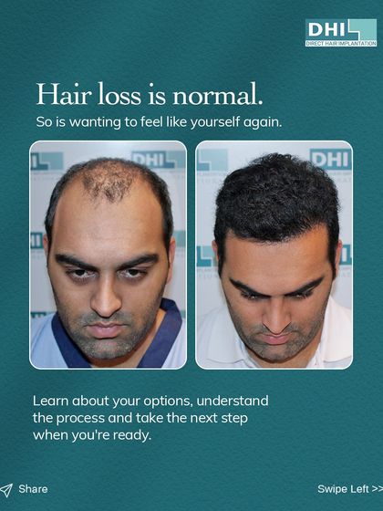 This before and after comparison shows how we help clients feel like themselves again. Our DHI procedure effectively restores lost hair, creating a fuller, natural look that rebuilds confidence.