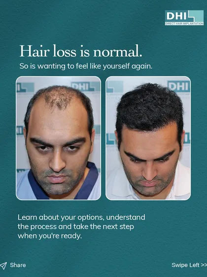 This before and after comparison shows how we help clients feel like themselves again. Our DHI procedure effectively restores lost hair, creating a fuller, natural look that rebuilds confidence.