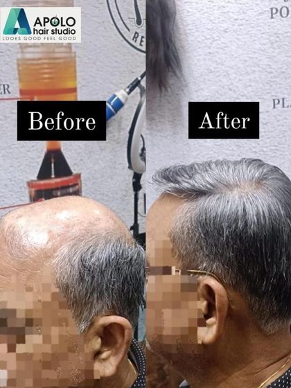 A fantastic result for a client with grey hair. Our custom hair patch seamlessly blends with his natural salt-and-pepper hair, covering the bald crown area and creating a very natural and age-appropriate style.