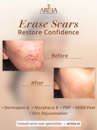 Acne, Scar & Pigmentation Correction