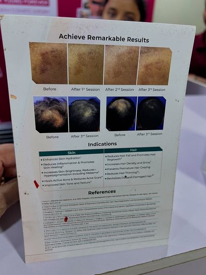 This is another view of the documented results from Exosome treatments. The progression photos clearly show the gradual improvement in both skin hyperpigmentation and hair thinning after just a few sessions, highlighting the therapy's dual-action benefits.
