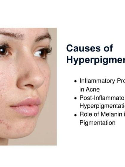 This image highlights hyperpigmentation as a common consequence of acne. My treatments address this by fading dark spots left behind after breakouts have healed, ensuring a truly clear complexion.