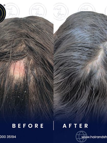 This before and after shows a successful treatment for Alopecia Areata, a condition causing patchy hair loss. With the right treatment, regrowth is possible.