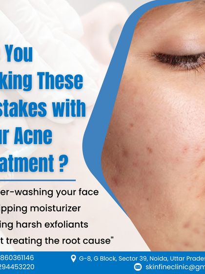 Are you making these common mistakes with your acne treatment? This graphic highlights errors like over washing and skipping moisturizer, which can worsen your skin condition.