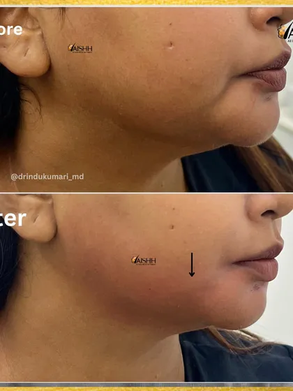 This side profile demonstrates how we can achieve a sharper, more sculpted jawline. The treatment targets the masseter muscles and sagging skin for a significant yet natural-looking improvement.