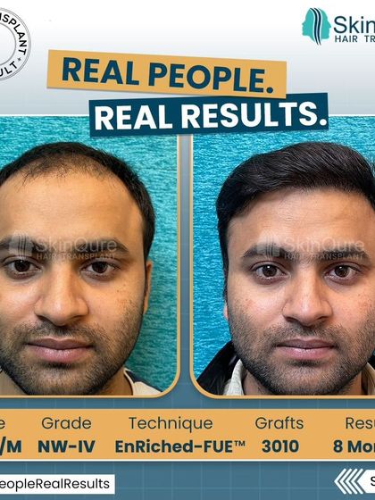 A frontal view of the 28-year-old patient's transformation. The before and after comparison clearly shows the restored hairline and increased density, which has significantly improved his facial framing.