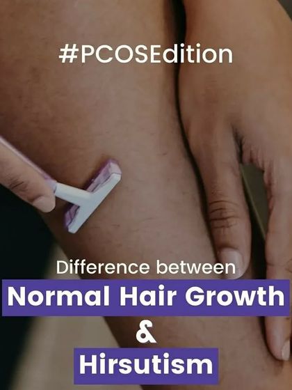 This infographic explains the difference between normal body hair and hirsutism, a common symptom of PCOS caused by high androgen levels.